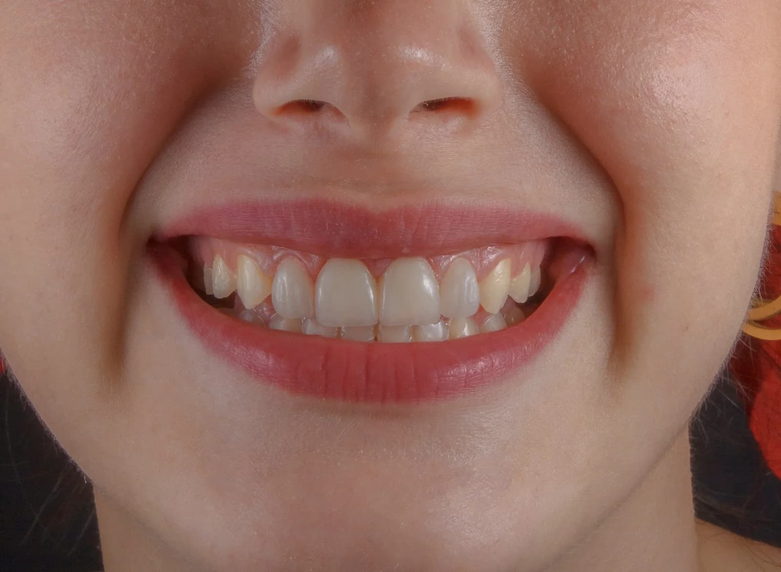 Oral care tools for protecting teeth at night